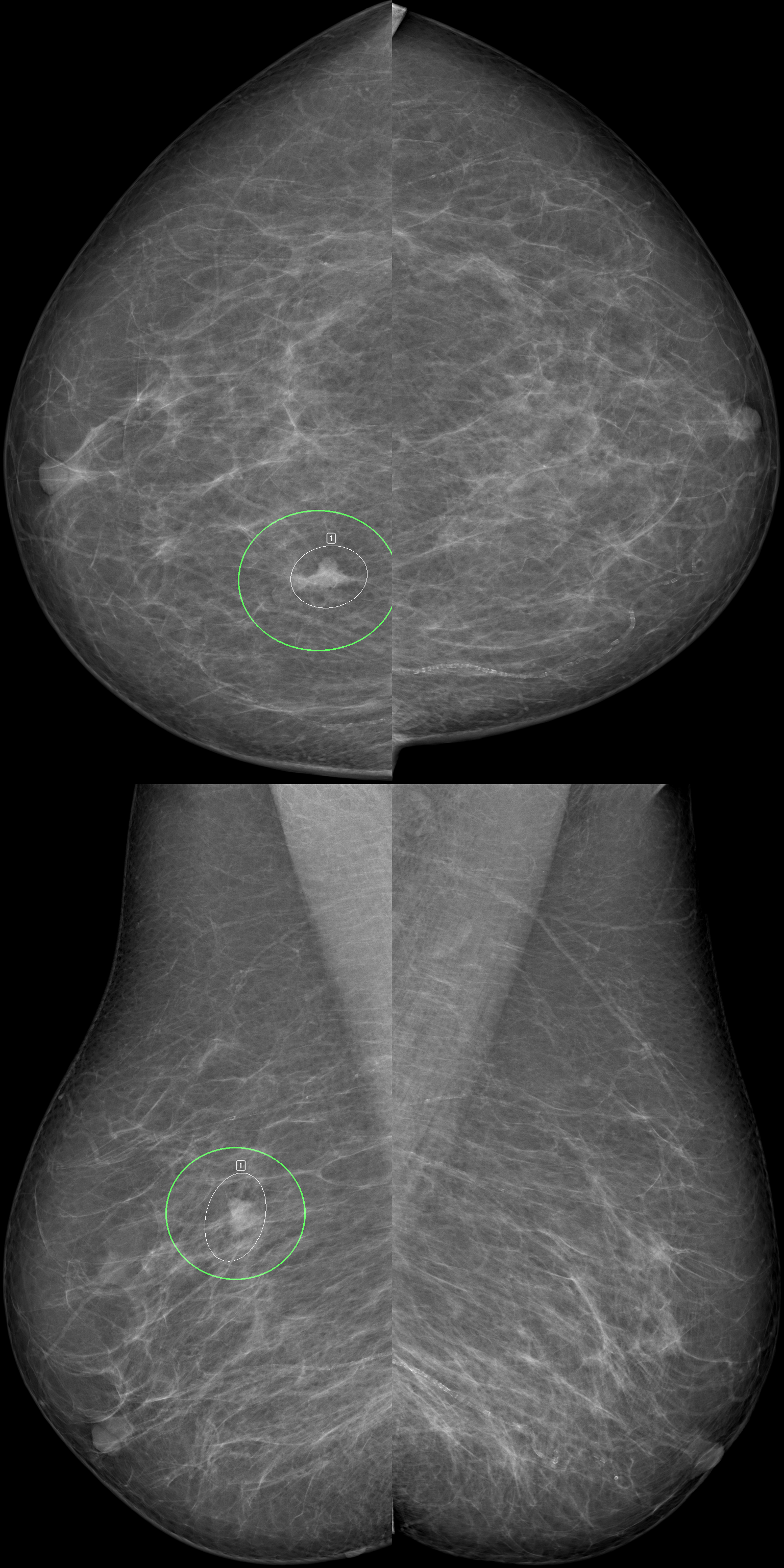 AI helps boost breast screening accuracy  